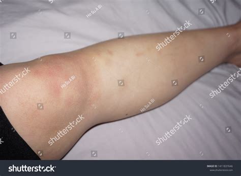 Many Mark Bruise Contusion On Knee Stock Photo 1411837646 | Shutterstock