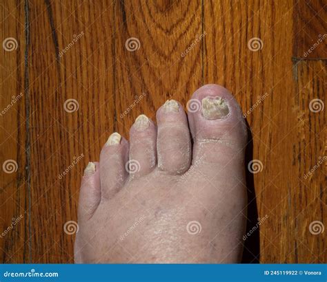 Toenail fungus stock photo. Image of onychomycosis, infection - 245119922