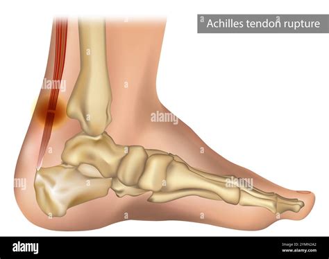 Achilles tendon rupture and injury Stock Vector Image & Art - Alamy