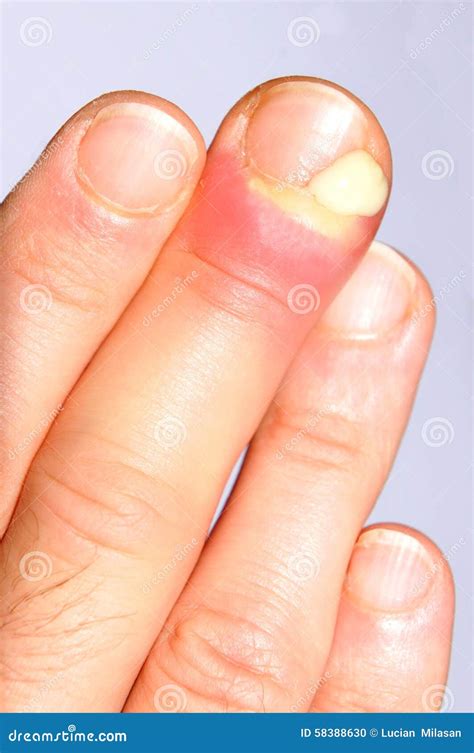 Infected Smashed Finger