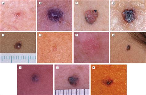 Malignant Melanoma Nodular