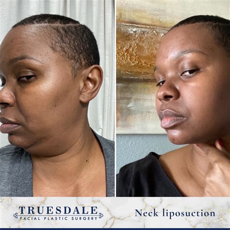 Neck (Submental) Liposuction Gallery