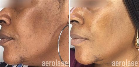 Aerolase Laser Treatment Hyperpigmentation Role in Dermatology
