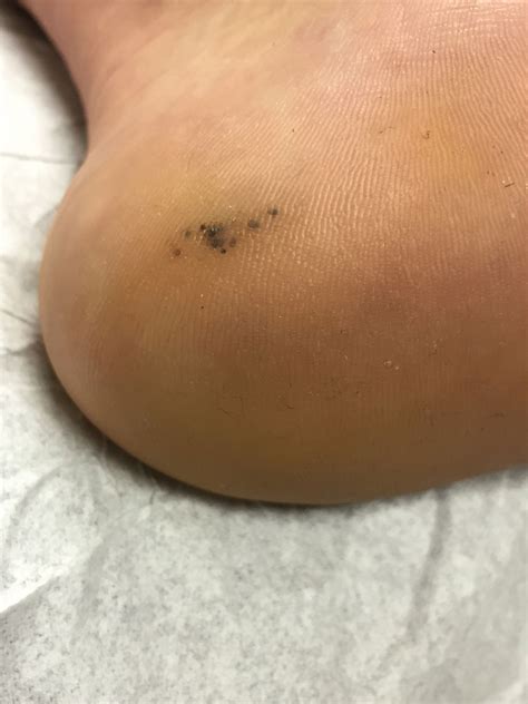 Black Dots Warts On Feet