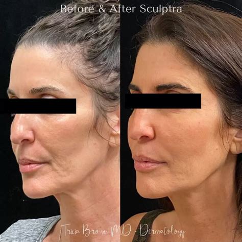 Facial Volume with Sculptra | Tricia Brown MD - Dermatology