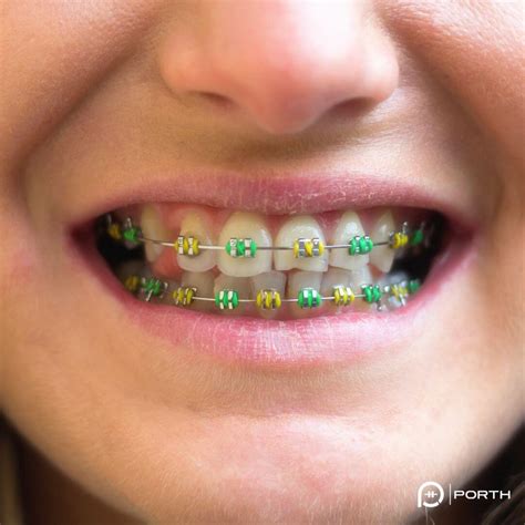 Green Colored Braces What The Colors Of Your Rubber Bands Mean L