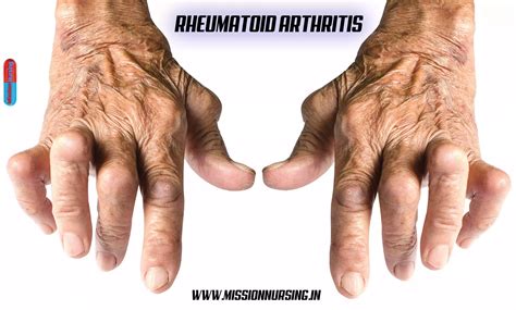 Rheumatoid arthritis >Causes, symptoms, treatment - Medical Surgical Nursing