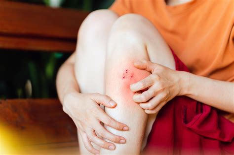 ¿Araña o mosquito? Guía para identificar picaduras de insectos