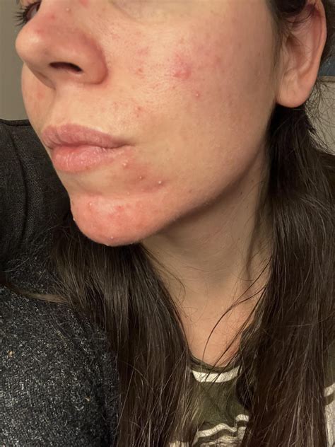 Does anyone else get little whiteheads that itch? I was diagnosed with acne rosacea but I’m ...