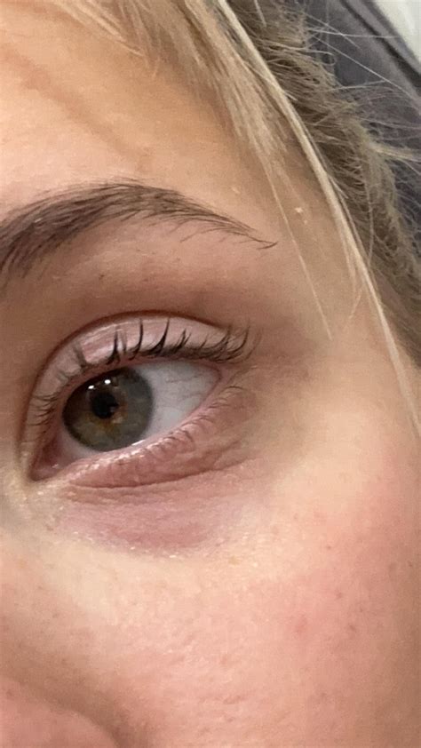 wrinkly & dry under eyes : r/DermatologyQuestions