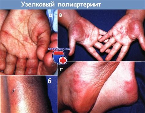 Узелковый полиартериит у детей. Диагностика и лечение