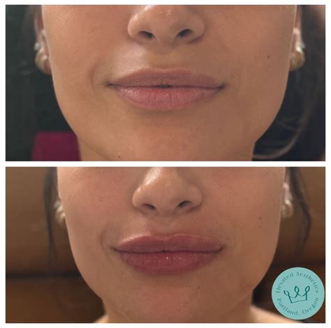 Elevated Aesthetics Results - Elevated Aesthetics