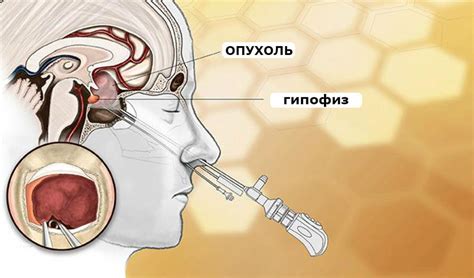 Опухоль гипофиза: симптомы, лечение и последствия