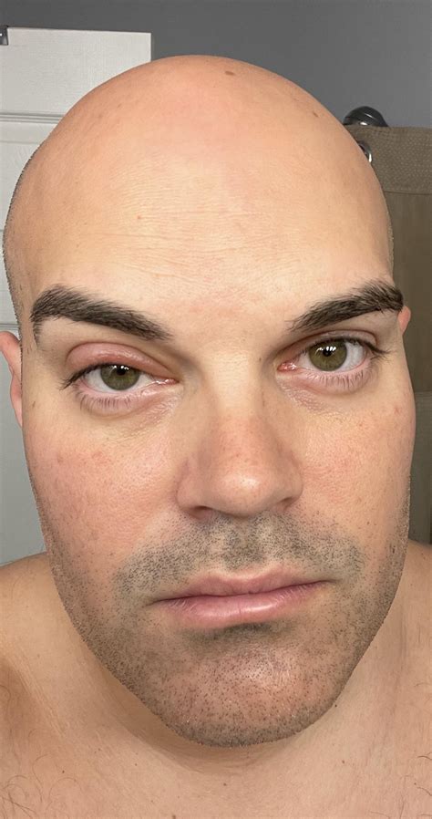 Eyelid swollen. : r/medical