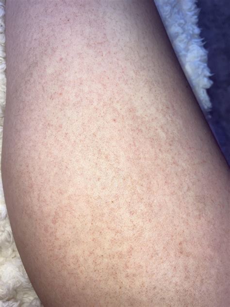 How To Relieve Tanning Bed Itch - Trackreply4