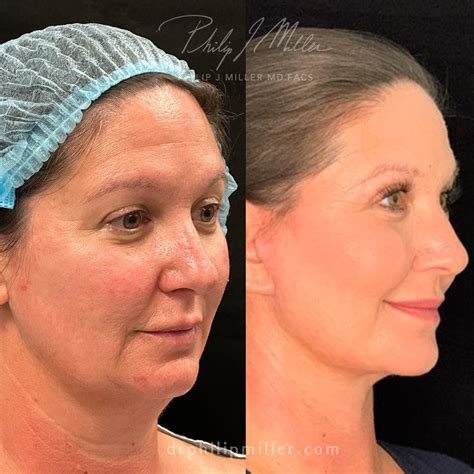 Mini Facelift in New York City - Philip Miller MD