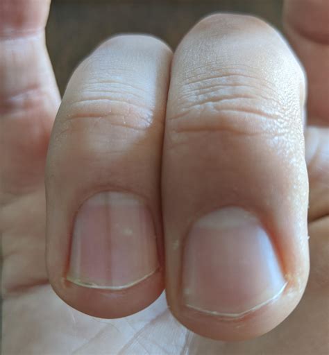 What Do Vertical Stripes On Fingernails Mean at Anthony Santiago blog