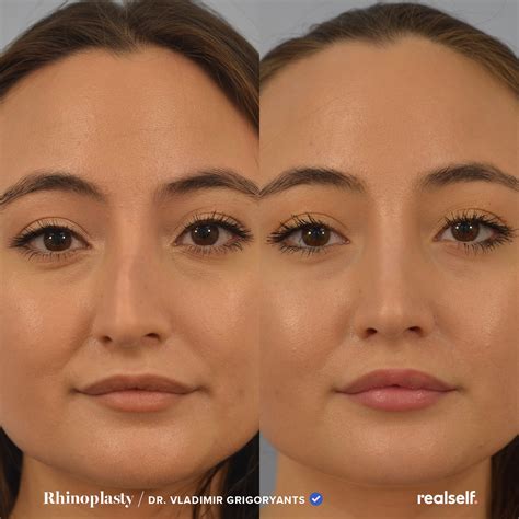 Nose Job Recovery Stages at Deborah Frias blog