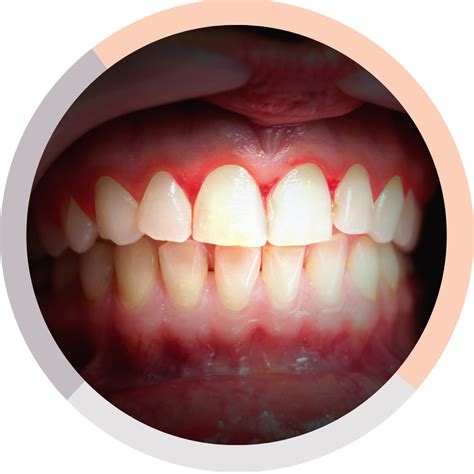 Bleeding/Swollen Gums - What to do Next? Melbourne Dentist in Malvern East