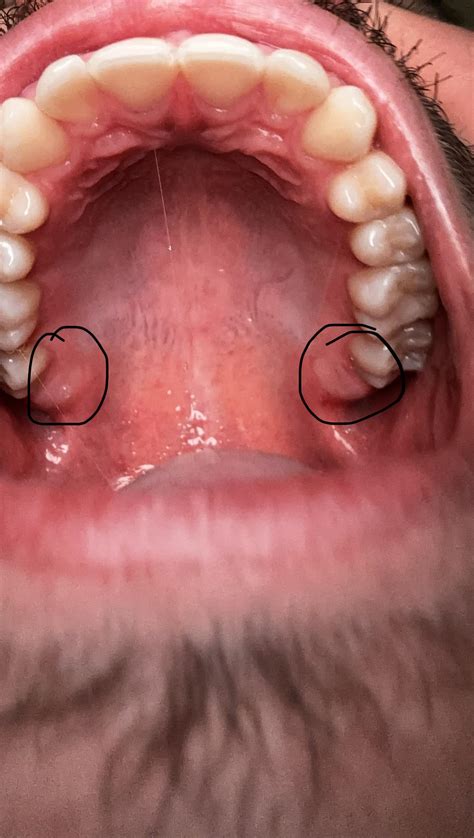 Presumably these are my wisdom teeth coming through , how long will they take to fully grow from ...