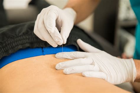 What is Dry Needling? - Tri-State Rehab Services