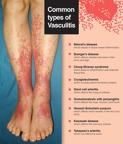 Vasculitis Symptoms New Vasculitis Guidelines: How Should You Treat