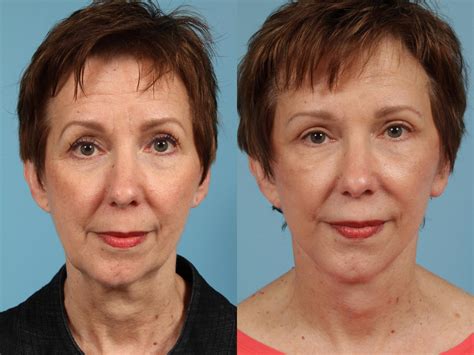 ‘Ozempic® Face’: What To Do About Facial Aging and Sagging Skin After Weight Loss – TLKM Plastic ...