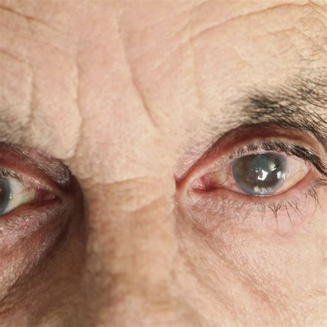 Symptoms of Cataracts - JPG Opticals