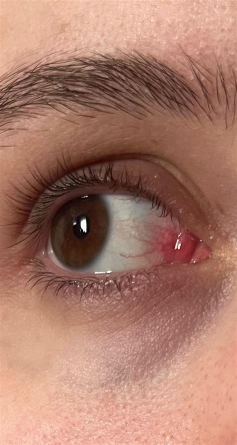 Redness and stinging in inner corner of right eye : r/Dryeyes