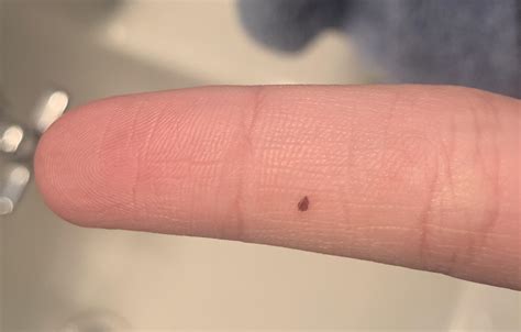 16M, Small Spot on finger. Noticed yesterday night. Not raised to the ...