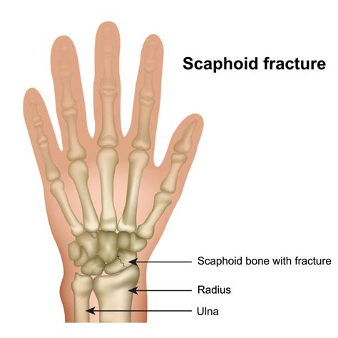 Scaphoid Fracture- Symptoms and Treatments | Panther Sports Medicine