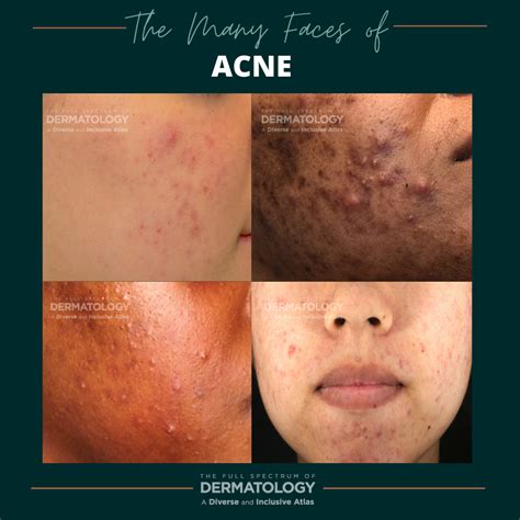 The Many Faces of Acne - Next Steps in Dermatology