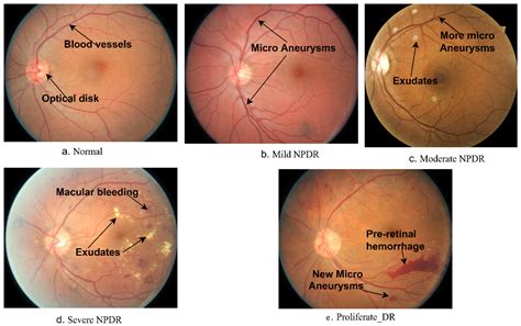Hybrid Methods for Fundus Image Analysis for Diagnosis of Diabetic Retinopathy Development ...