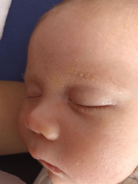 Can cradle cap spread to under eye? : r/newborns