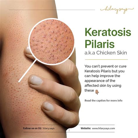 Hilary Says | Skincare | Keratosis Pilaris (aka Chicken Skin) is a common, harmless skin ...