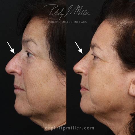 To Fix Deviated Septum Surgery