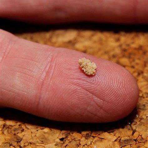 Kidney Stone 4mm