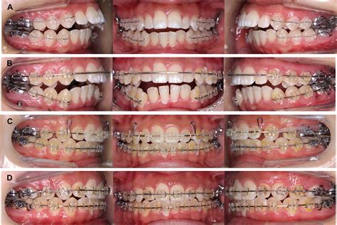 A case of anterior open bite associated with idiopathic condylar resorption treated with ...