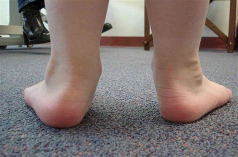 Flat Feet In Kids | Leading Health Podiatry