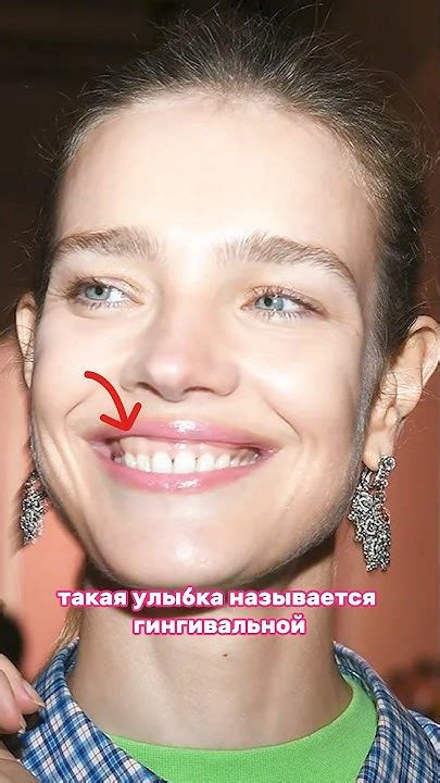 Как убрать десневую улыбку? Самый простой способ - YouTube