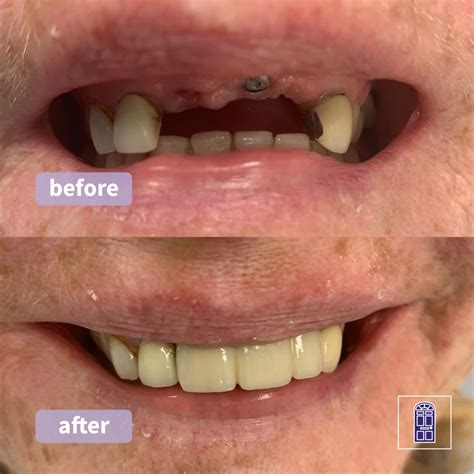 Dental Implants York | Permanent Tooth Replacement