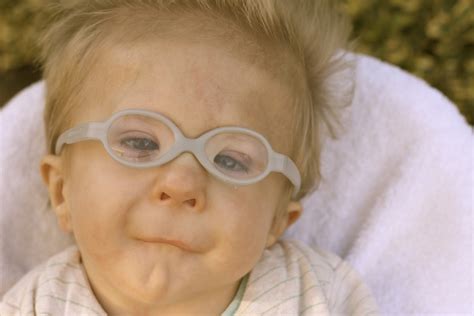 Sindrome De Freeman Sheldon - RETOEDU