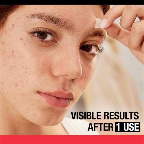 Neutrogena Stubborn Acne Pimple Patches Review – hydrocolloid pimple ...