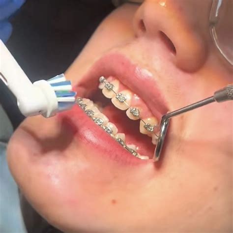 Cleaning Fixed Braces — Dental Smiles Flagstaff, Colchester