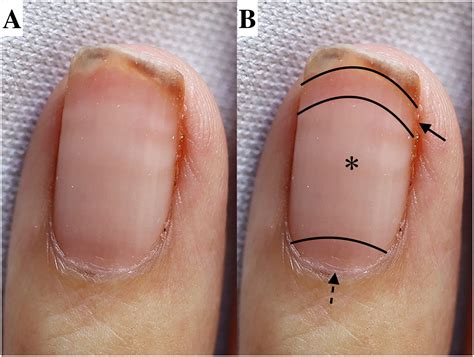 Red Lunulae, White Nails, and Cirrhosis - The American Journal of Medicine