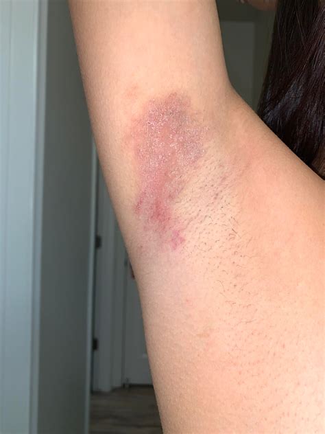 can someone please tell me what this weird armpit rash is ): : r/skin