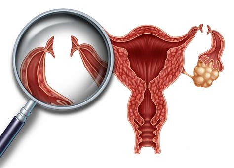 Tubal Ligation in Turkey | Cost of Tubal Ligation in Turkey