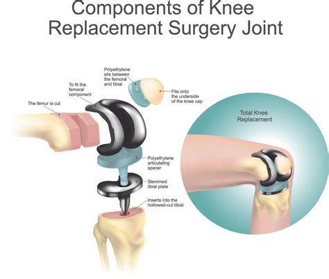 Total Knee Replacement (TKR) | Dr A. Theodorides Knee Surgeon Specialist