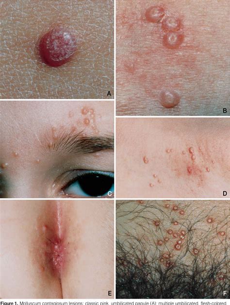 Figure 1 from Molluscum contagiosum: the need for physician intervention and new treatment ...