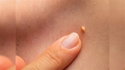 Warts Removing : పులిపిర్లు పోవాలా.. ఇలా చేయండి.. - how do you get rid ...